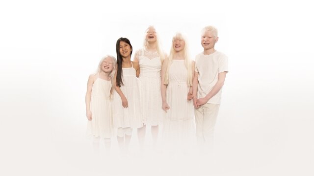 Born With Albinism