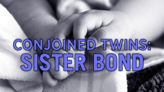 Conjoined Twins: Sister Bond