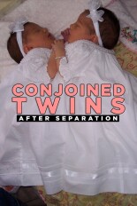 Conjoined Twins: After Separation